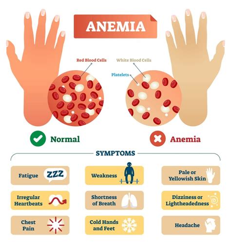 va disability for anemia|VA Rating For Anemia .
